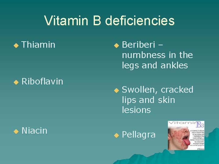 Vitamin B deficiencies u Thiamin u Riboflavin u u u Niacin u Beriberi –