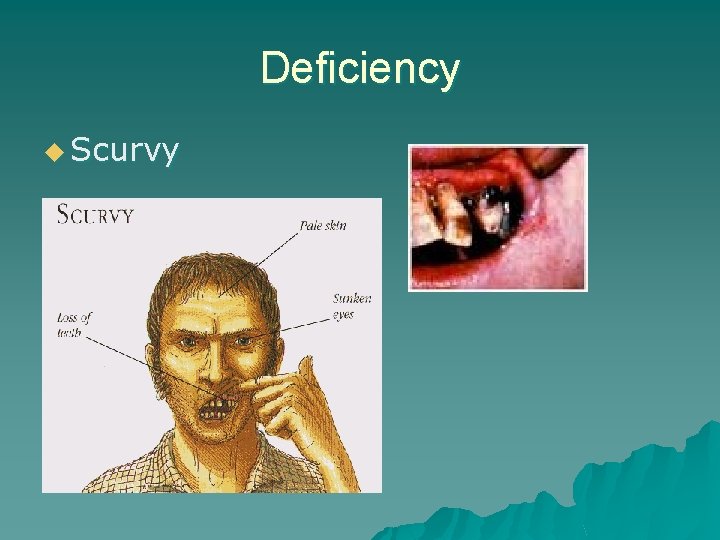 Deficiency u Scurvy 