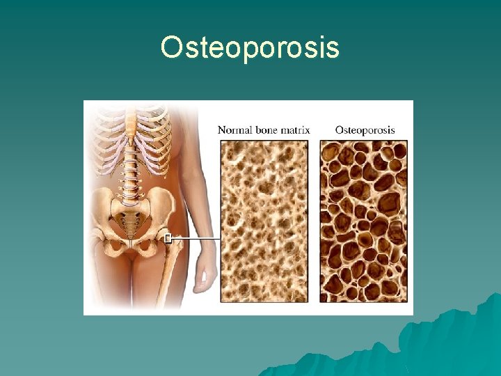 Osteoporosis 