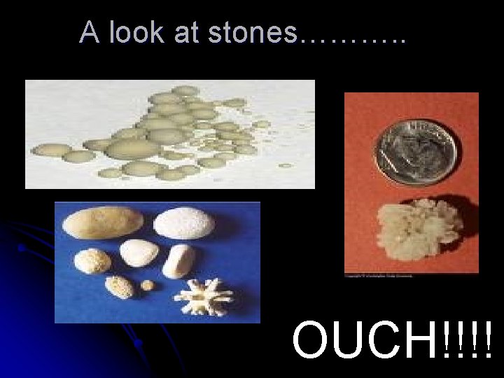 A look at stones………. . OUCH!!!! 