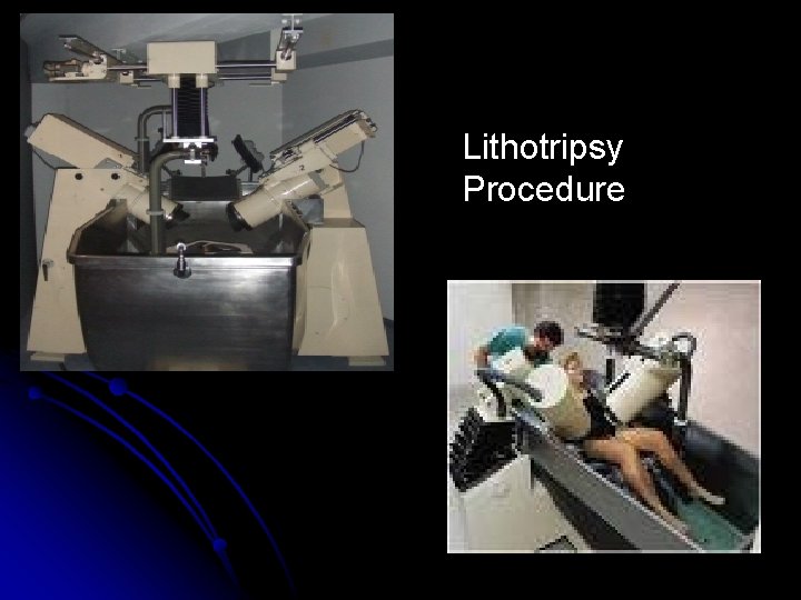 Lithotripsy Procedure 