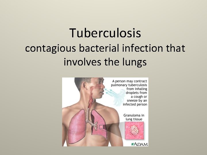 Tuberculosis contagious bacterial infection that involves the lungs 