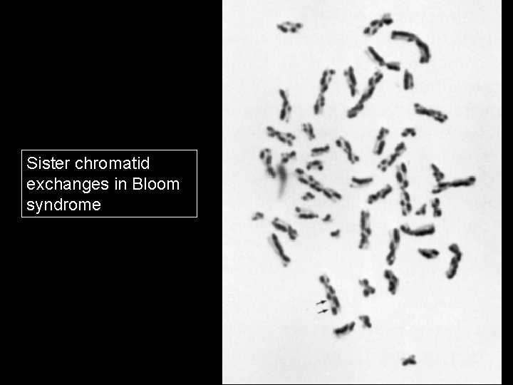 Sister chromatid exchanges in Bloom syndrome 