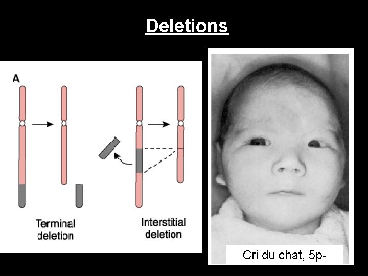 Deletions Cri du chat, 5 p- 