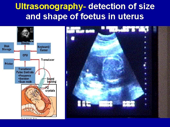 Ultrasonography- detection of size and shape of foetus in uterus 