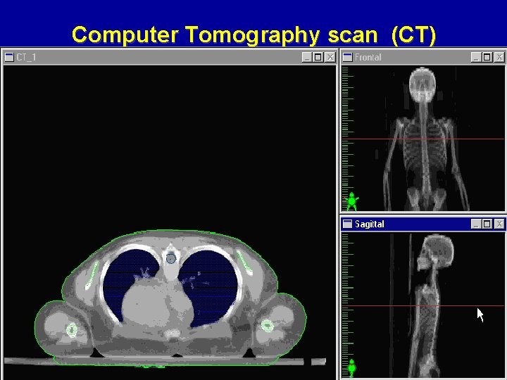 Computer Tomography scan (CT) 