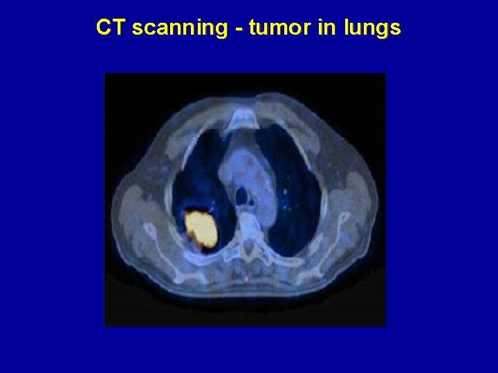 CT scanning - tumor in lungs 