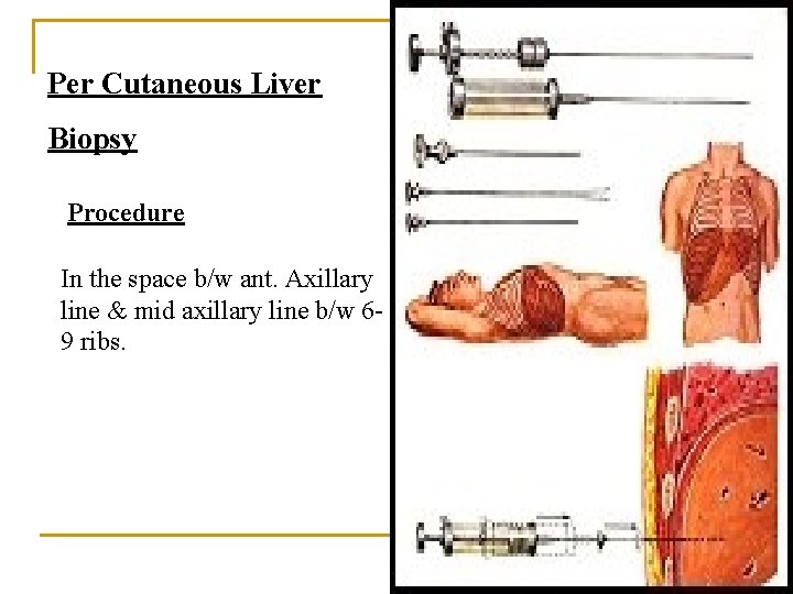 Per Cutaneous Liver Biopsy Procedure In the space b/w ant. Axillary line & mid