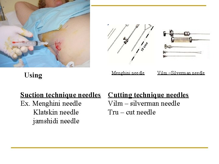 Using Suction technique needles Ex. Menghini needle Klatskin needle jamshidi needle Menghini needle Vilm