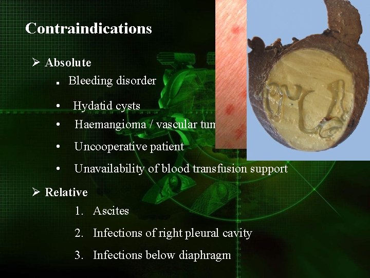 Contraindications Ø Absolute. Bleeding disorder • Hydatid cysts • Haemangioma / vascular tumors •