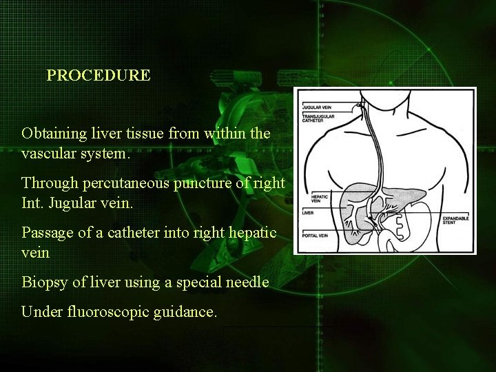 PROCEDURE Obtaining liver tissue from within the vascular system. Through percutaneous puncture of right