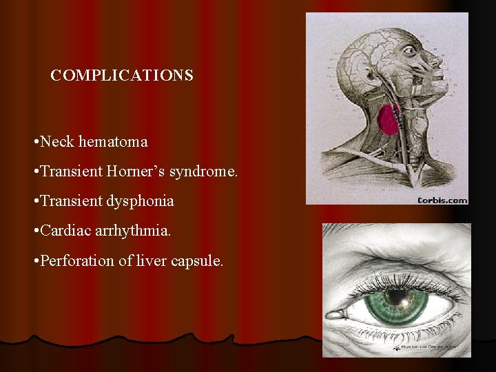 COMPLICATIONS • Neck hematoma • Transient Horner’s syndrome. • Transient dysphonia • Cardiac arrhythmia.