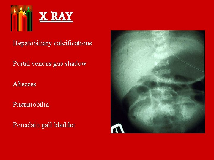 X RAY Hepatobiliary calcifications Portal venous gas shadow Abscess Pneumobilia Porcelain gall bladder 