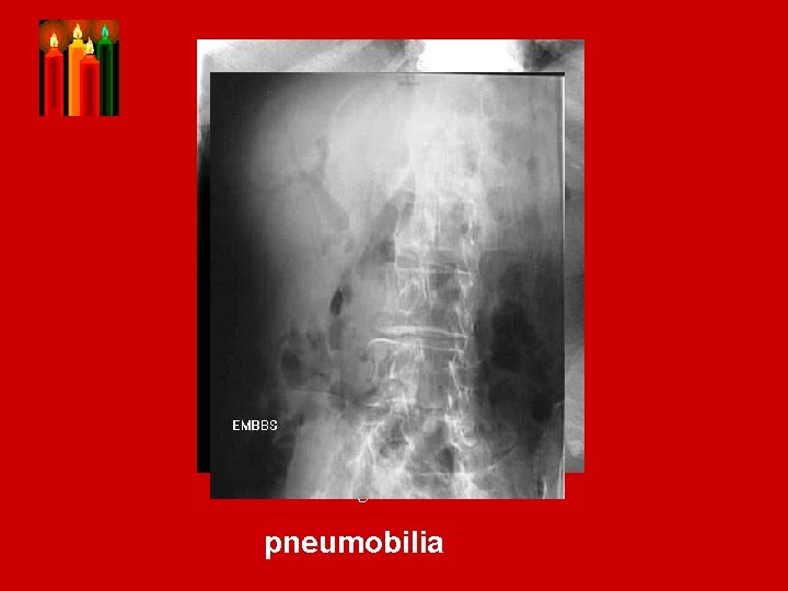 Porcelian gallbladder pneumobilia 