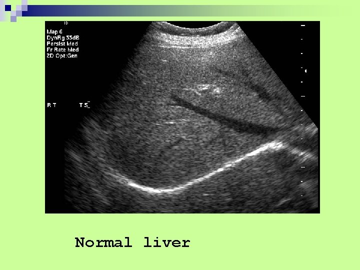 Normal liver 