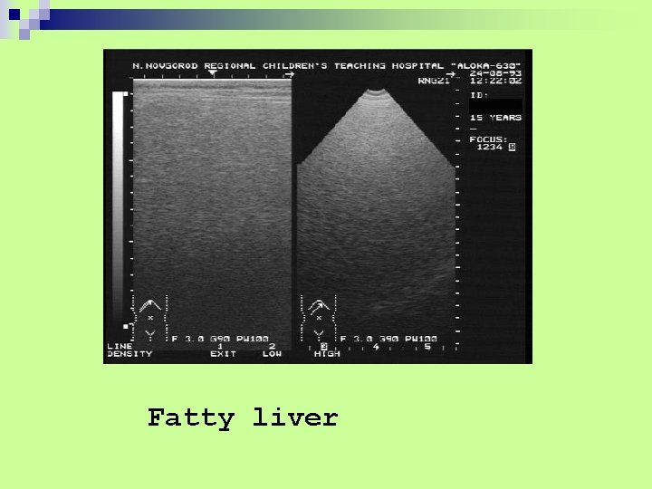 Fatty liver 