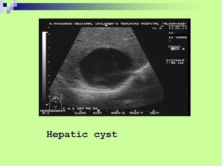Hepatic cyst 
