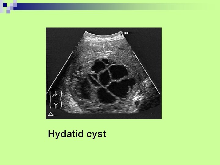 Hydatid cyst 