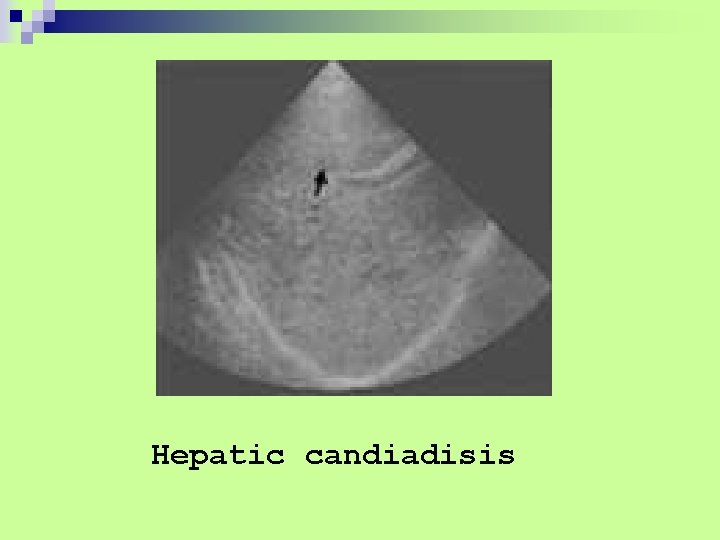 Hepatic candiadisis 