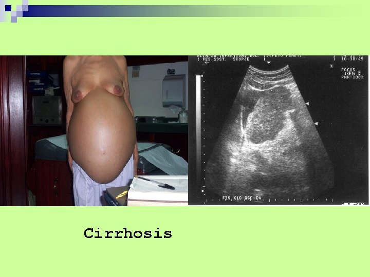 Cirrhosis 