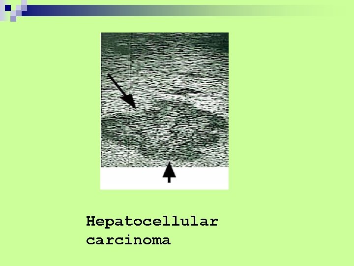 Hepatocellular carcinoma 