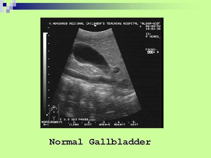 Normal Gallbladder 