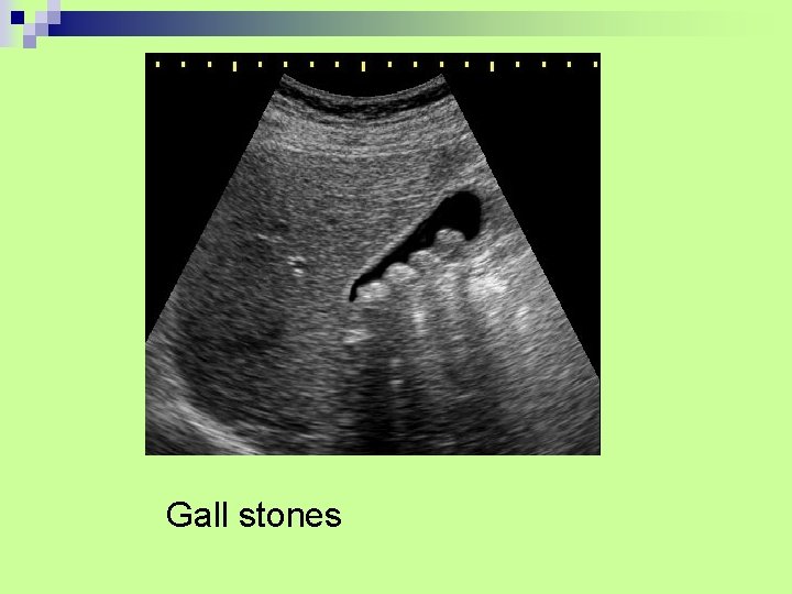 Gall stones 