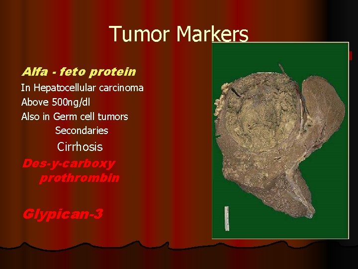 Tumor Markers Alfa - feto protein In Hepatocellular carcinoma Above 500 ng/dl Also in