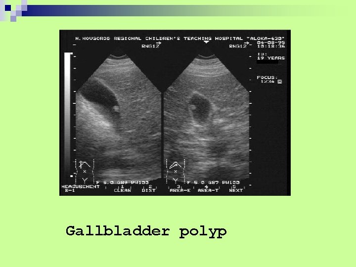 Gallbladder polyp 