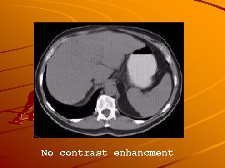 No contrast enhancment 