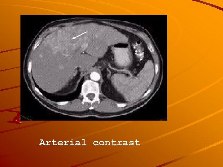 Arterial contrast 