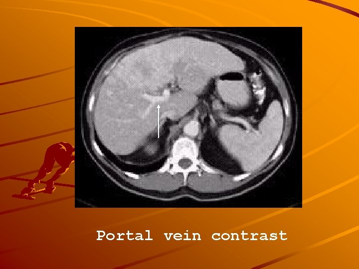 Portal vein contrast 