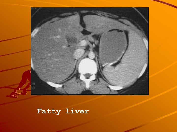 Fatty liver 