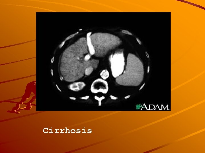 Cirrhosis 