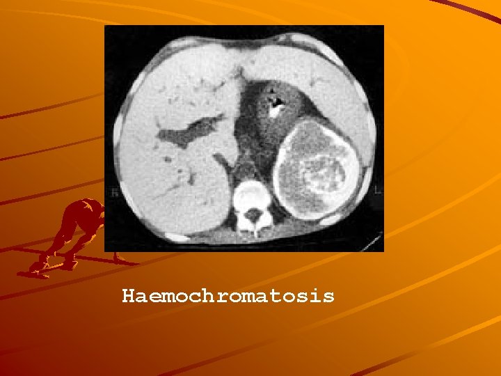Haemochromatosis 