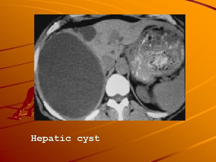 Hepatic cyst 
