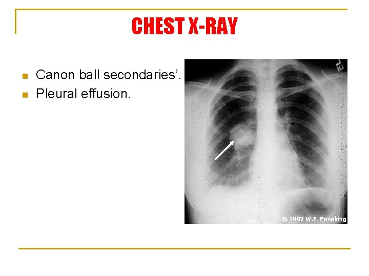CHEST X-RAY n n Canon ball secondaries’. Pleural effusion. 