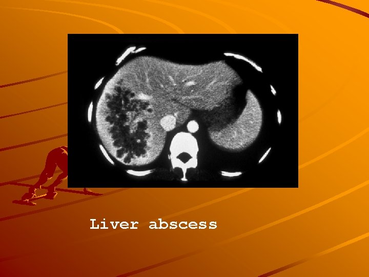 Liver abscess 