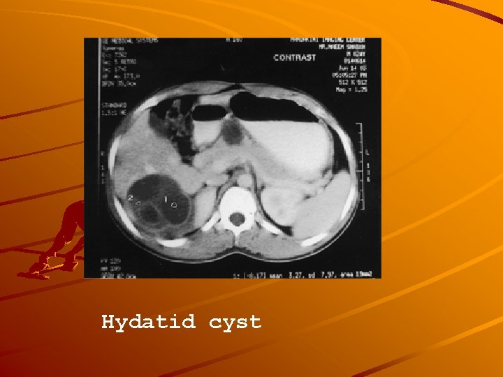Hydatid cyst 