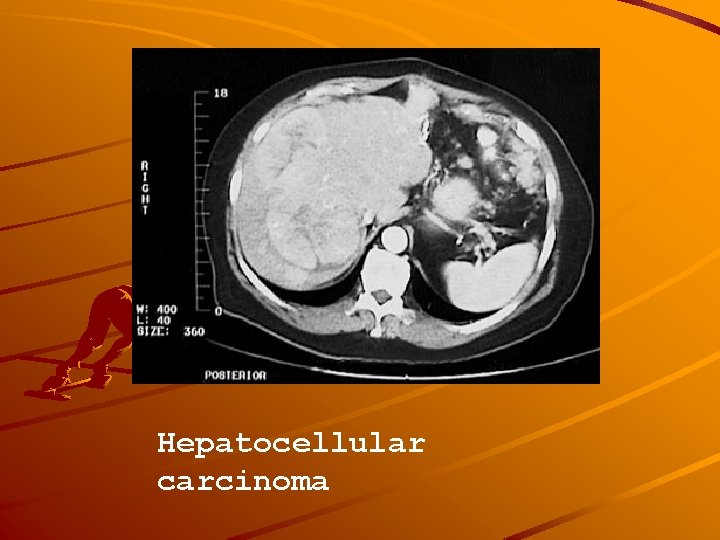 Hepatocellular carcinoma 