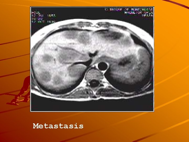 Metastasis 