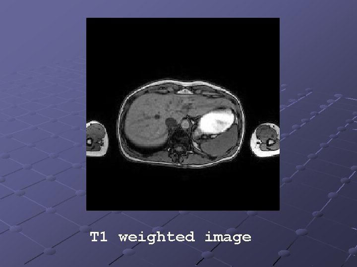 T 1 weighted image 