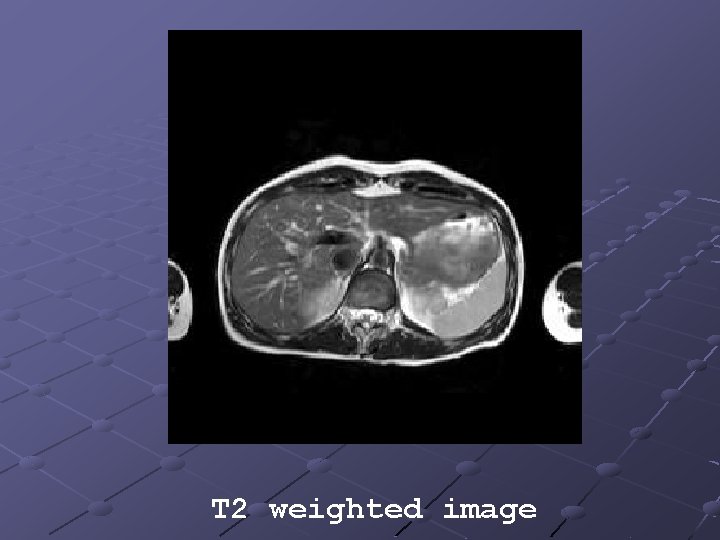 T 2 weighted image 