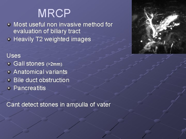 MRCP Most useful non invasive method for evaluation of biliary tract Heavily T 2
