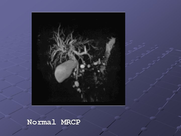 Normal MRCP 