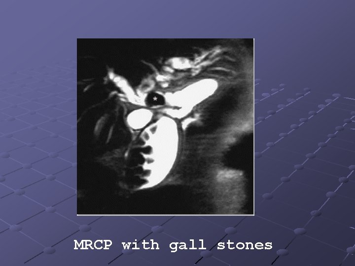 MRCP with gall stones 