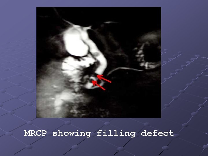 MRCP showing filling defect 