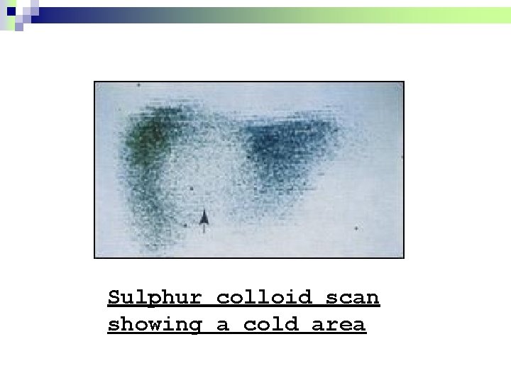 Sulphur colloid scan showing a cold area 