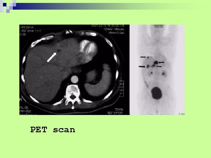 PET scan 