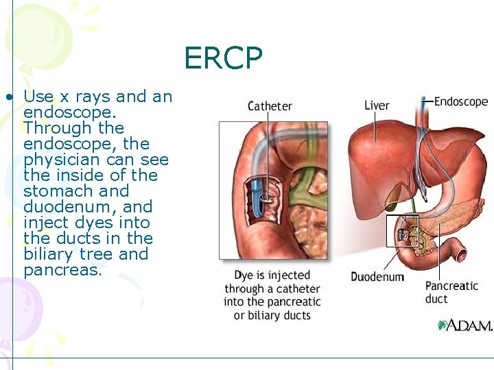 ERCP • Use x rays and an endoscope. Through the endoscope, the physician can